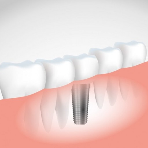 Když se rozhodnete pro zubní implantát, vyžadujte kvalitu!