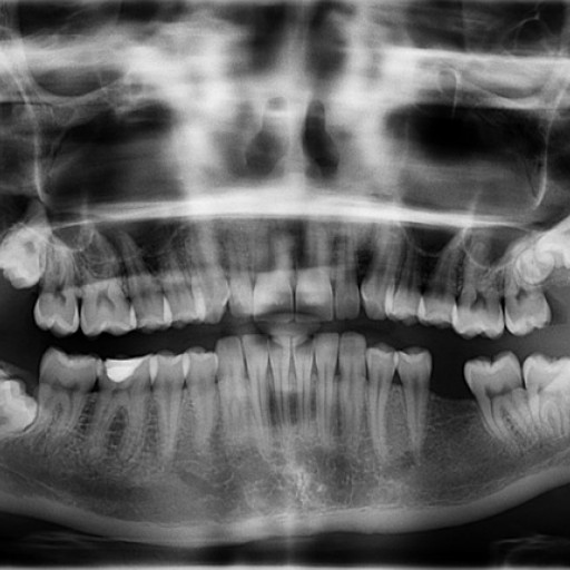 Máte neúplný chrup? Chybějící zub je nutné nahradit! 