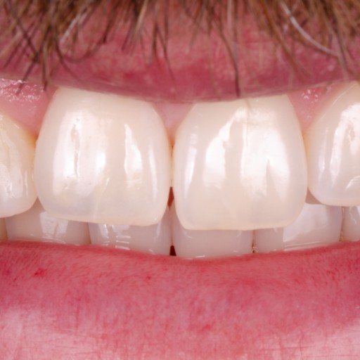 Zavedení zubního implantátu
