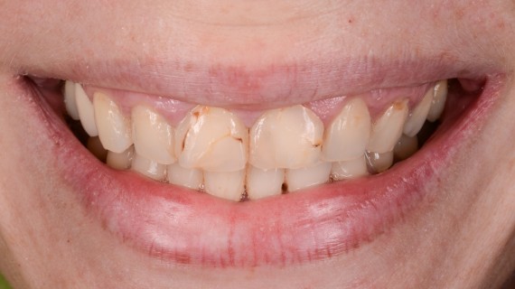 Nevyhovující fotokompozitní výplně - foto před