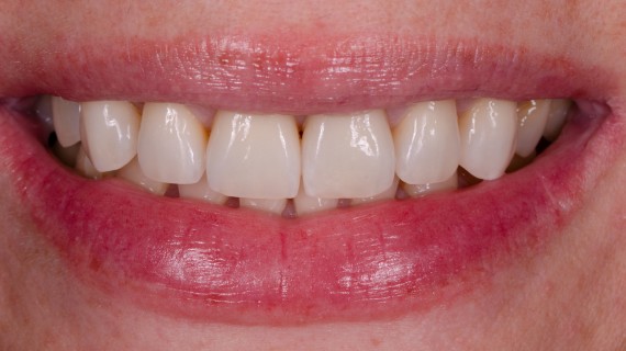 Nevyhovující fotokompozitní výplně - foto po