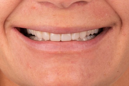 Neinvazivní rekonstrukce předních zubů bez preparace